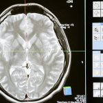 Scientists find new way to predict memory loss in Alzheimer’s disease