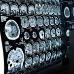 Seizures may increase dementia risk for stroke survivors