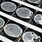 New study finds a promising treatment for dementia