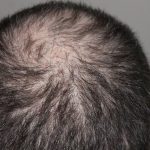 This study shows a new cause of hair loss