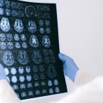 What happens inside artery plaque to trigger strokes