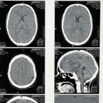 Scientists find a better way to predict Alzheimer’s disease
