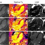 Advanced MRI benefits people with heart stiffening disease