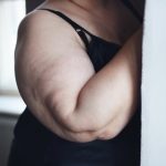 Obesity-related brain symptoms mimic Alzheimer’s disease