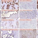 Scientists discover HIV vaccine may also fight cancer