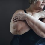 Why weight loss surgery could lower heart failure risk