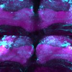 Scientists find new genes linked to early-onset Parkinson’s