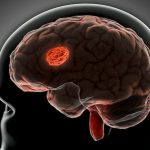 What causes brain cancer?