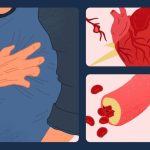 Warning signs of arterial blockages in the heart