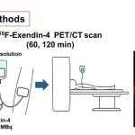 New scan could detect rare insulin-producing tumors without surgery