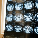 Scientists find how to reset brain’s cleanup cells to treat Alzheimer’s