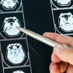 Ischemic stroke: what’s the right treatment?