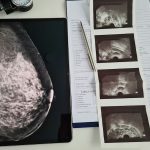 New imaging can detect aggressive breast cancer more effectively