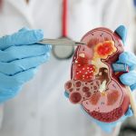 Eat smart to prevent kidney stones