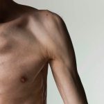 Study finds a painful shoulder disease for people with diabetes