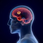 Study finds surprising cause of brain bleeds in older people