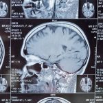 A natural compound that can fight against stroke