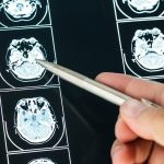 New ultrasound helmet can safely reach deep brain areas without surgery