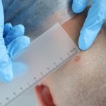 Common blood pressure drug may increase skin cancer risk, study finds