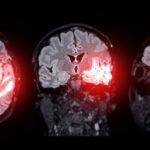 New nanotech treatment reverses Alzheimer’s disease