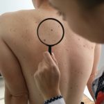 A common blood pressure pill may increase skin cancer risk