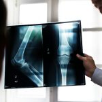 How hidden inflammation in aging bone marrow may trigger blood cancer