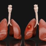 Lung cancer is still the deadliest in the world, but the hope is growing