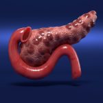 Study finds a new early warning sign of pancreatic cancer