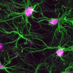 Scientists identify hidden source of brain damage that could trigger dementia