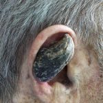 Why some humans grow horns