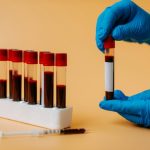 Reducing ‘bad’ cholesterol to very low levels may protect stroke survivors