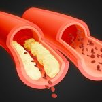 Early warning signs of blocked arteries everyone needs to know