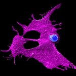 New therapy can stop pancreatic cancer even after it spreads to liver and lungs