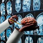 New AI tool can detect stroke and brain cancer faster