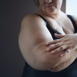 Why is obesity linked to irregular heart rhythms? Researchers found 1 potential mechanism