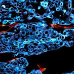 New discovery may help doctors spot dangerous oral cancer earlier