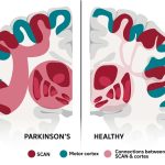 Scientists identify key brain network behind Parkinson’s Disease
