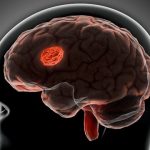 Scientists discover a hidden cause of brain bleeding