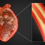 Cholesterol drugs statins may affect brain, weight, and lung health