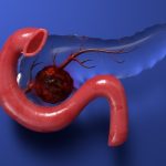 Nerves may help pancreatic cancer start much earlier than expected, study finds
