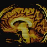 Can Doctors Put the Brain into a Safe ‘Hibernation’ After a Stroke?