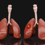 Scientists Find Powerful Drug Combo for Tough Lung Cancer