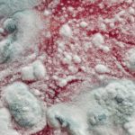 Deadly Mould Infections In Hosptials May Be More Common Than Expected