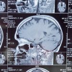 Preventing Brain Injuries Starts Before the Hospital